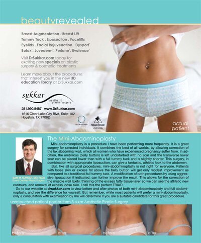 THE MINI-ABDOMINOPLASTY