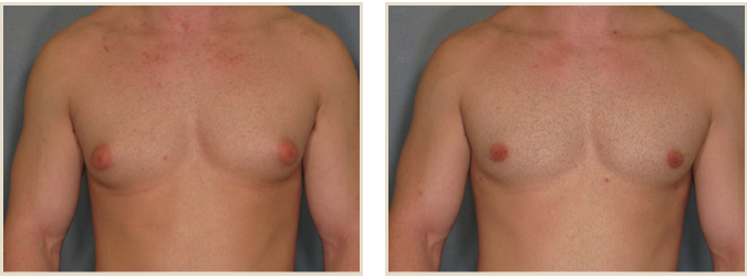 TWO TECHNIQUES FOR GYNECOMASTIA TREATMENT