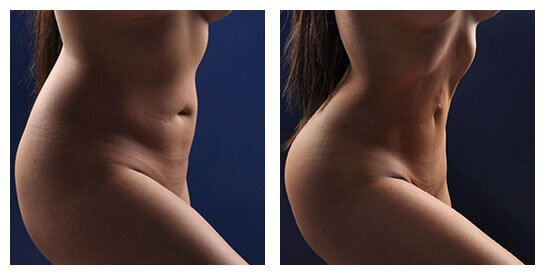 GAIN CONTOUR AND SHAPE WITH VASER® LIPOSCULPTURE