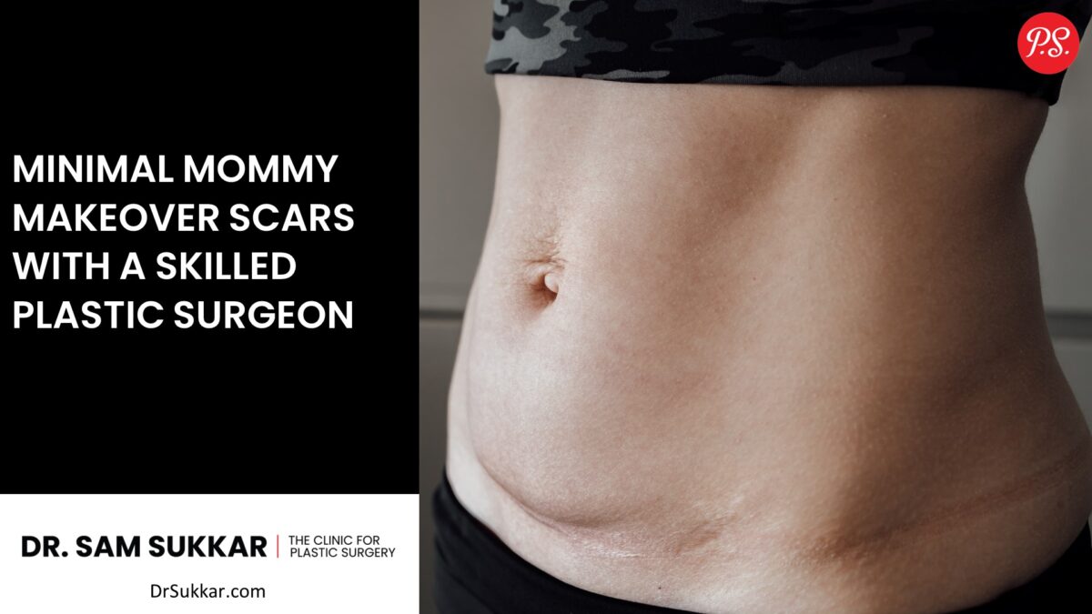 Minimal Mommy Makeover Scars with a Skilled Plastic Surgeon