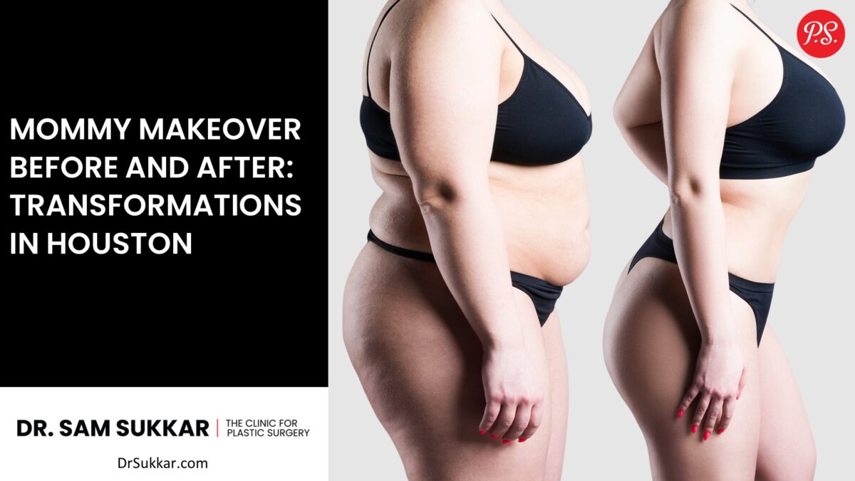 Mommy Makeover Before and After: Transformations in Houston