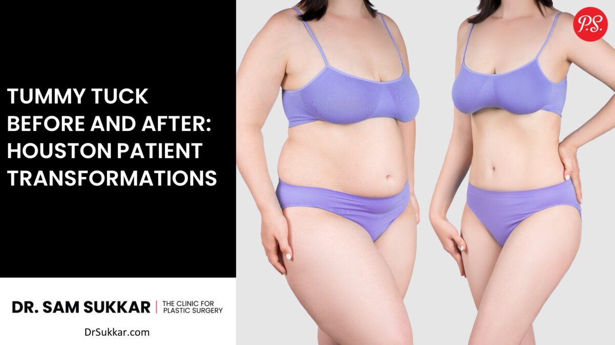 Tummy Tuck Before and After: Houston Patient Transformations