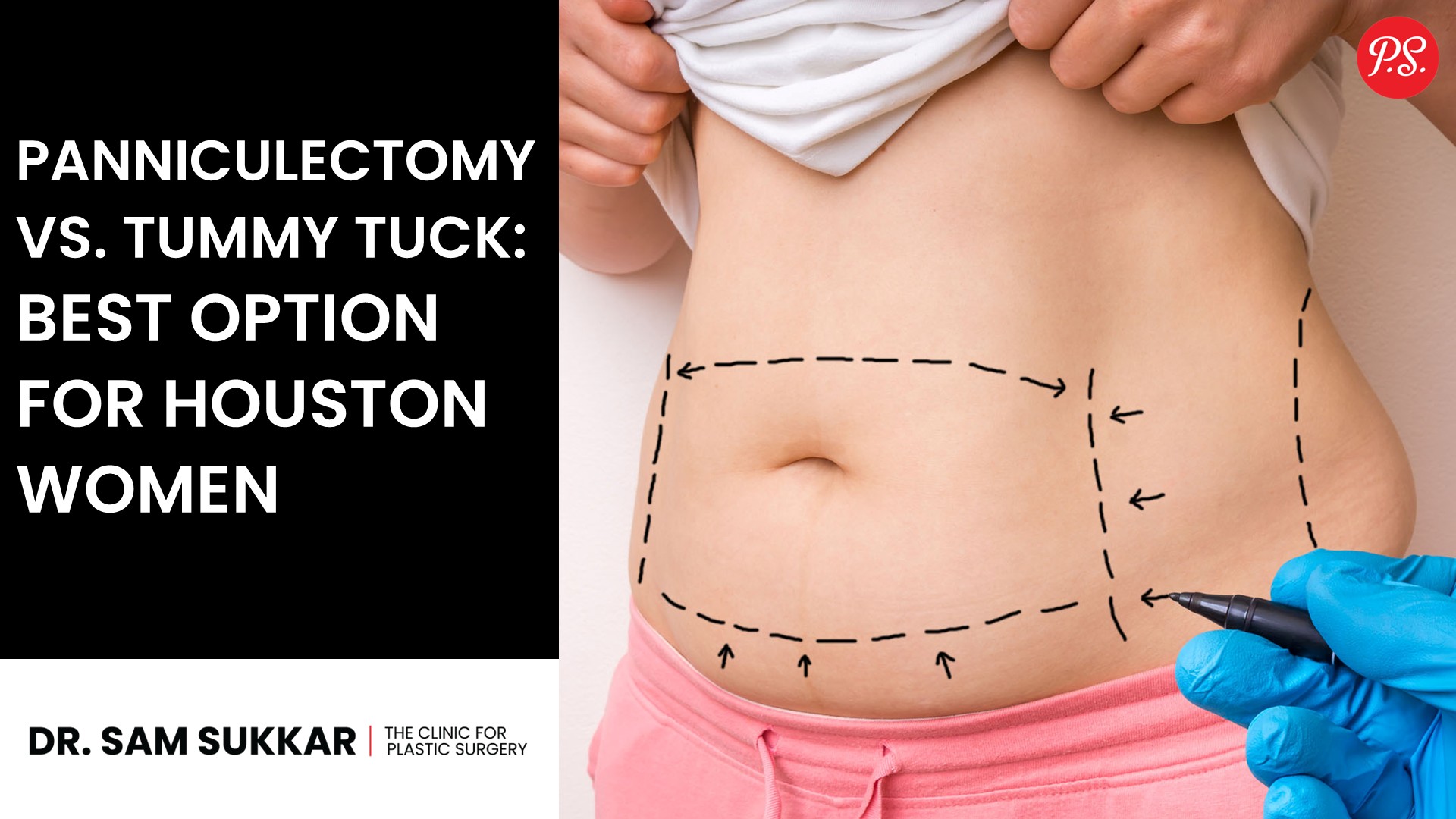 Panniculectomy vs Tummy Tuck: Best Option for Houston Women
