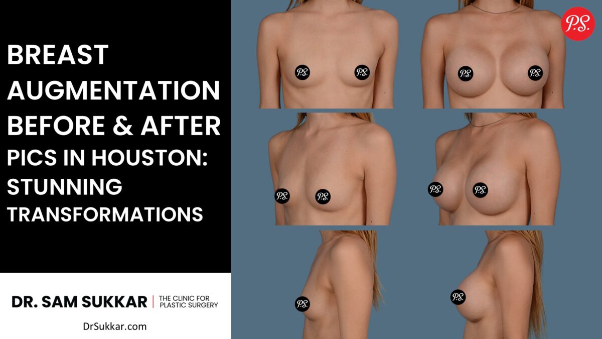 Breast Augmentation Before and After Pics in Houston: Stunning Transformations by Dr. Sam Sukkar, MD