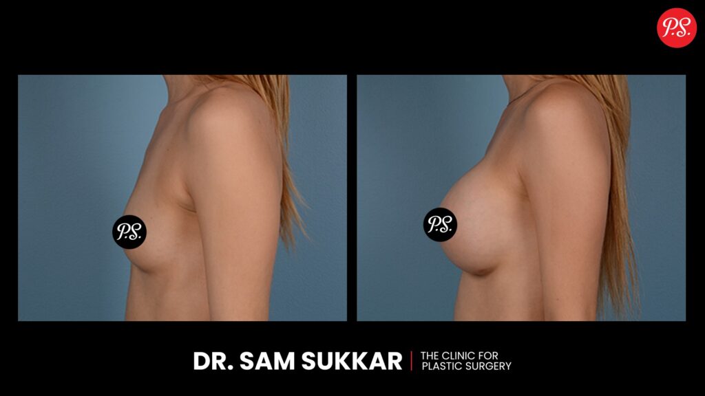 Breast Augmentation Before and After in Houston, TX by Dr. Sam Sukkar, MD