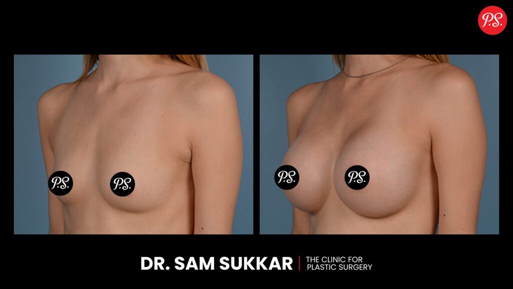 Breast Augmentation Before and After in Houston, TX - Dr. Sam Sukkar, MD
