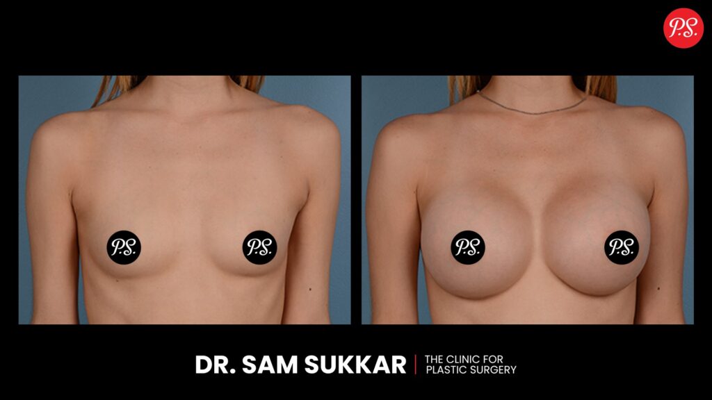 Breast Augmentation Before and After in Houston, Texas by Dr. Sam Sukkar, MD