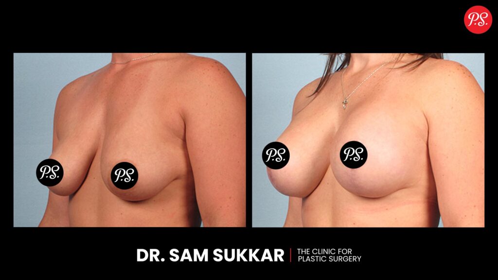 Breast Implants Before and After: Houston, Texas' Patient Transformations by Dr. Sam Sukkar