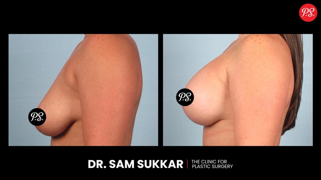 Breast Implants Before and After: Houston's Transformations by Dr. Sam Sukkar, MD