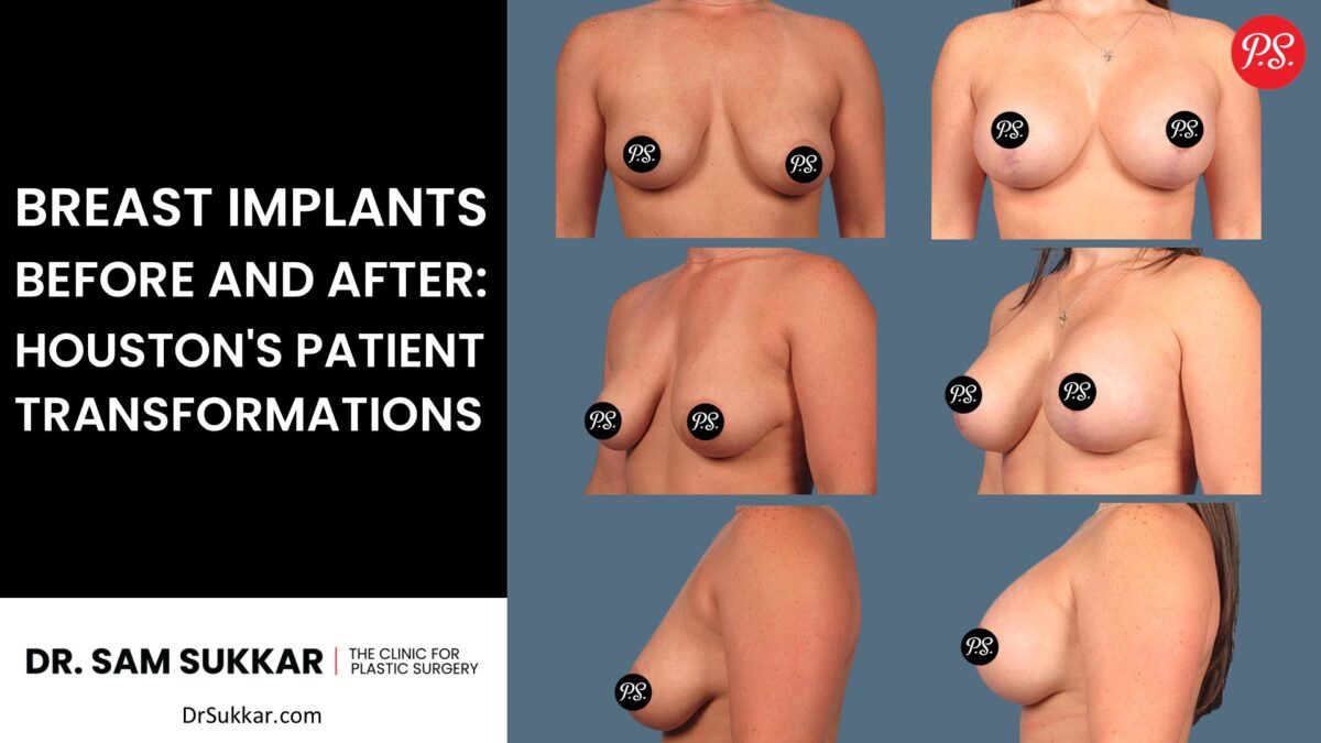 Breast Implants Before and After: Houston's Patient Transformations by Dr. Sam Sukkar, MD