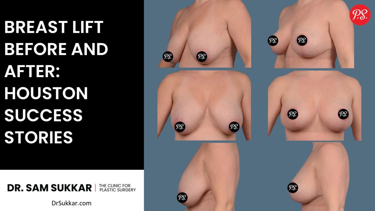 Breast Lift Before and After: Houston Success Stories by Dr. Sam Sukkar, MD