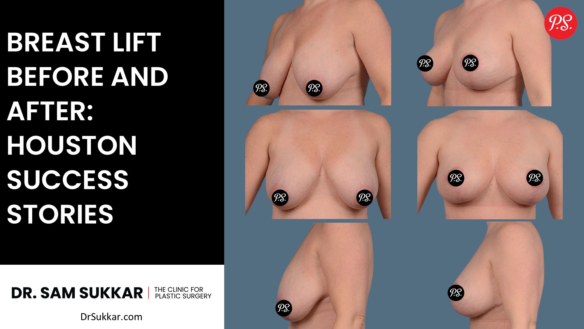 Breast Lift Before and After: Houston Success Stories