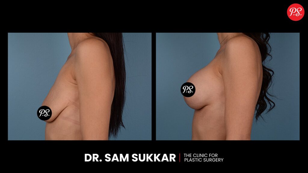 Breast Lift and Augmentation Before and After in Houston, TX By Dr. Sam Sukkar