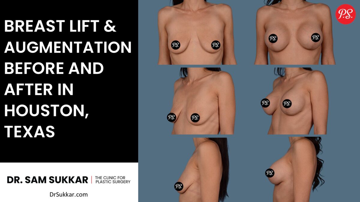 Breast Lift and Augmentation Before and After in Houston, Texas by Dr. Sam Sukkar, MD
