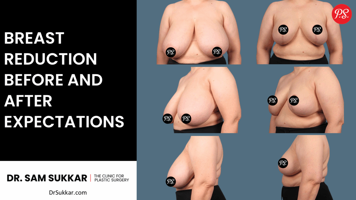 Breast Reduction Before and After Expectations by Dr. Sam Sukkar, MD