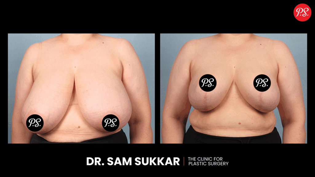 Breast Reduction Before and After Expectations in Houston, TX by Dr. Sam Sukkar