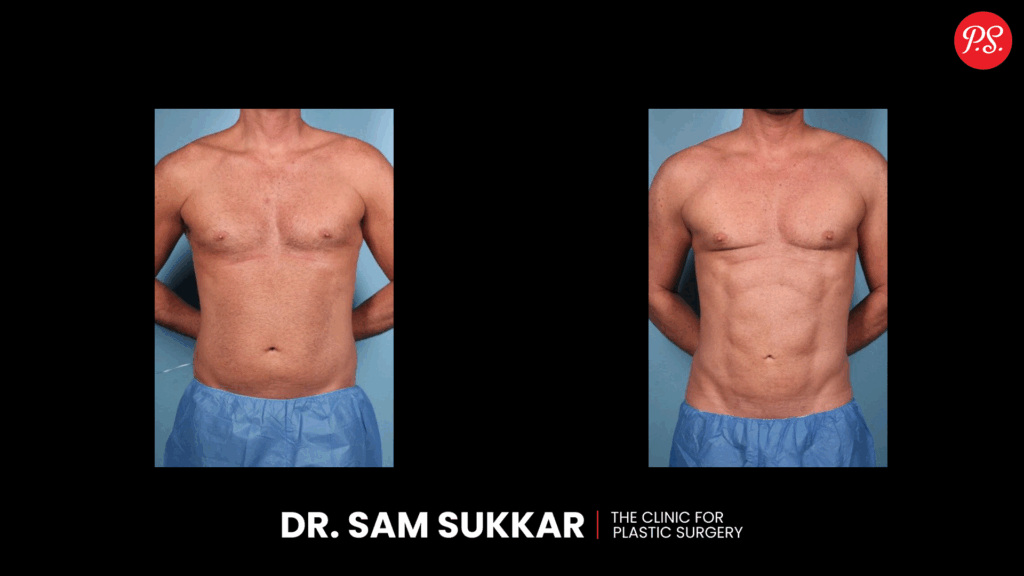 Liposuction Before and After in Houston by Dr. Sam Sukkar