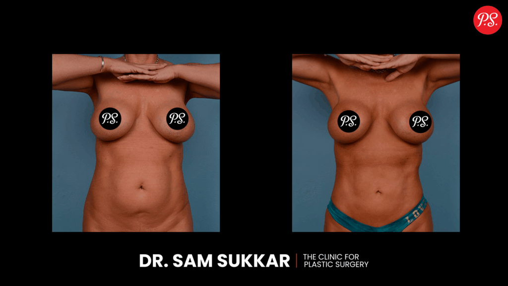 Liposuction Surgery Before and After in Houston by Dr. Sam Sukkar