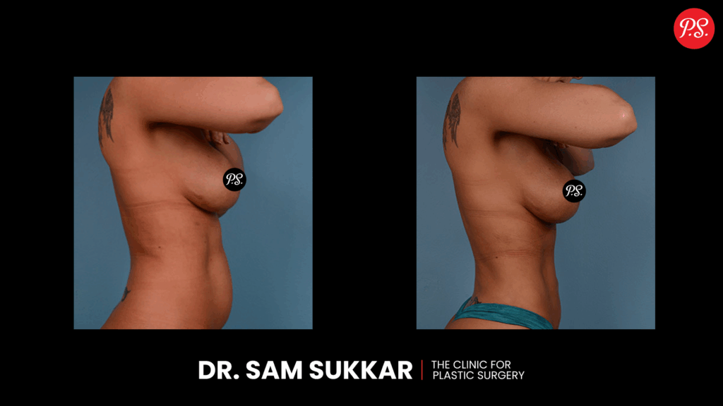 Before and After Liposuction in Houston by Dr. Sam Sukkar
