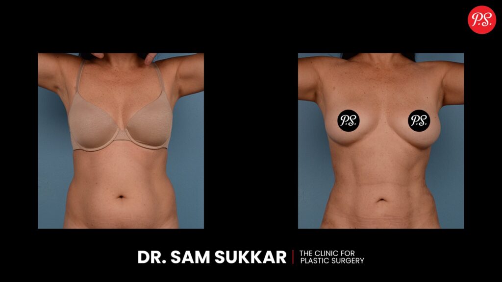 Laser Liposuction Before and After Results By Dr. Sam Sukkar, MD In Houston, Texas