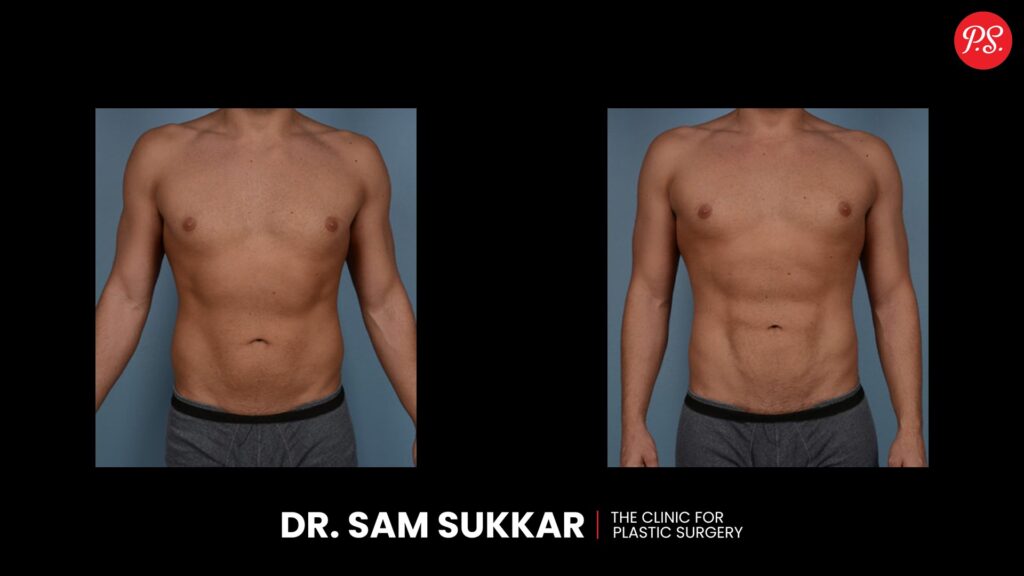 Liposuction Before and After for Men in Houston, TX: Stunning Transformations by Dr. Sam Sukkar, MD