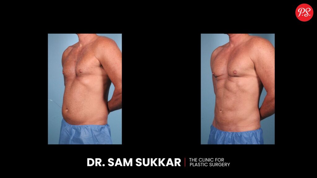Liposuction Before and After for Men in Houston, Texas by Dr. Sam Sukkar, MD