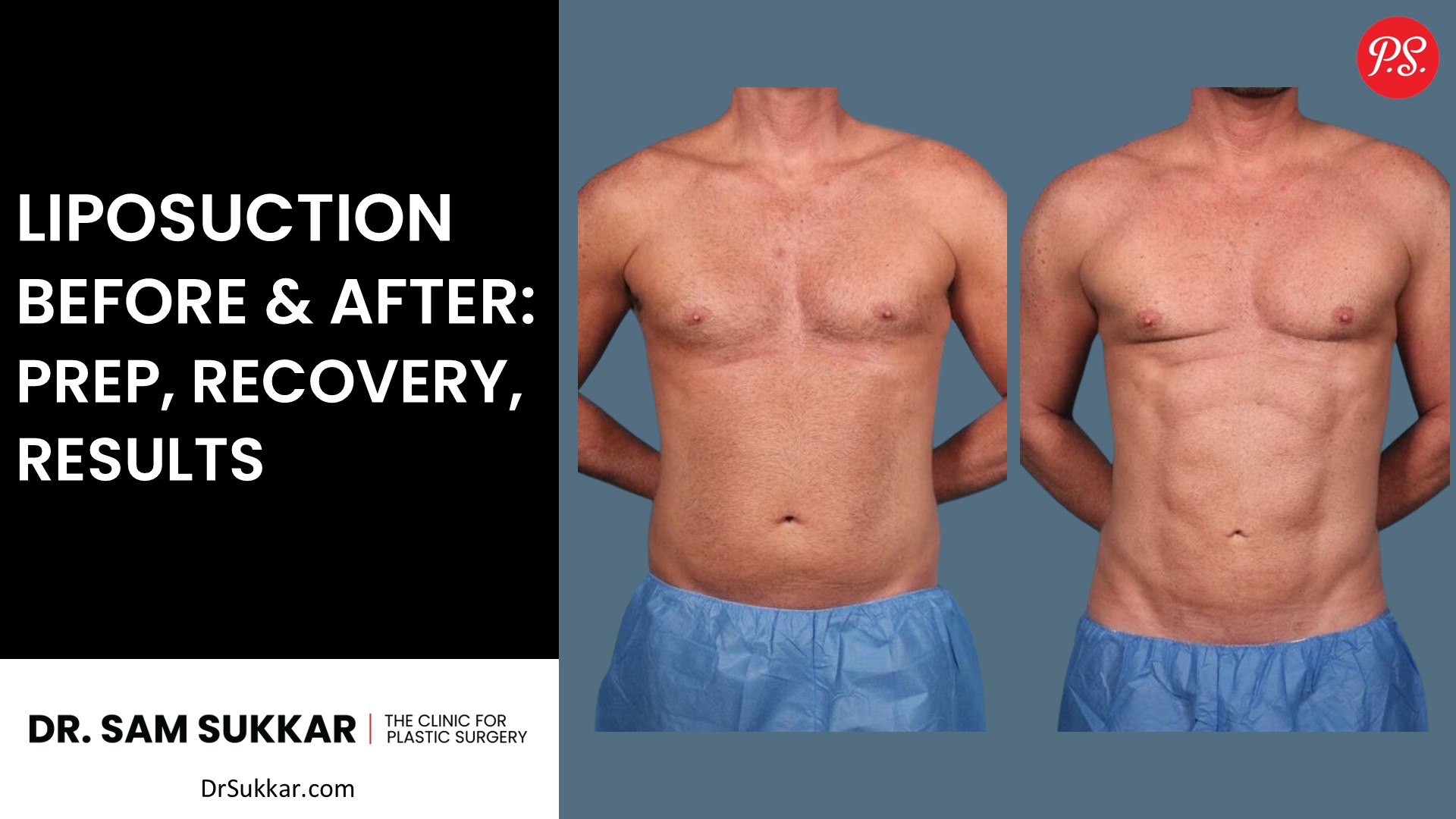 Liposuction Before and After for Men: Stunning Transformations