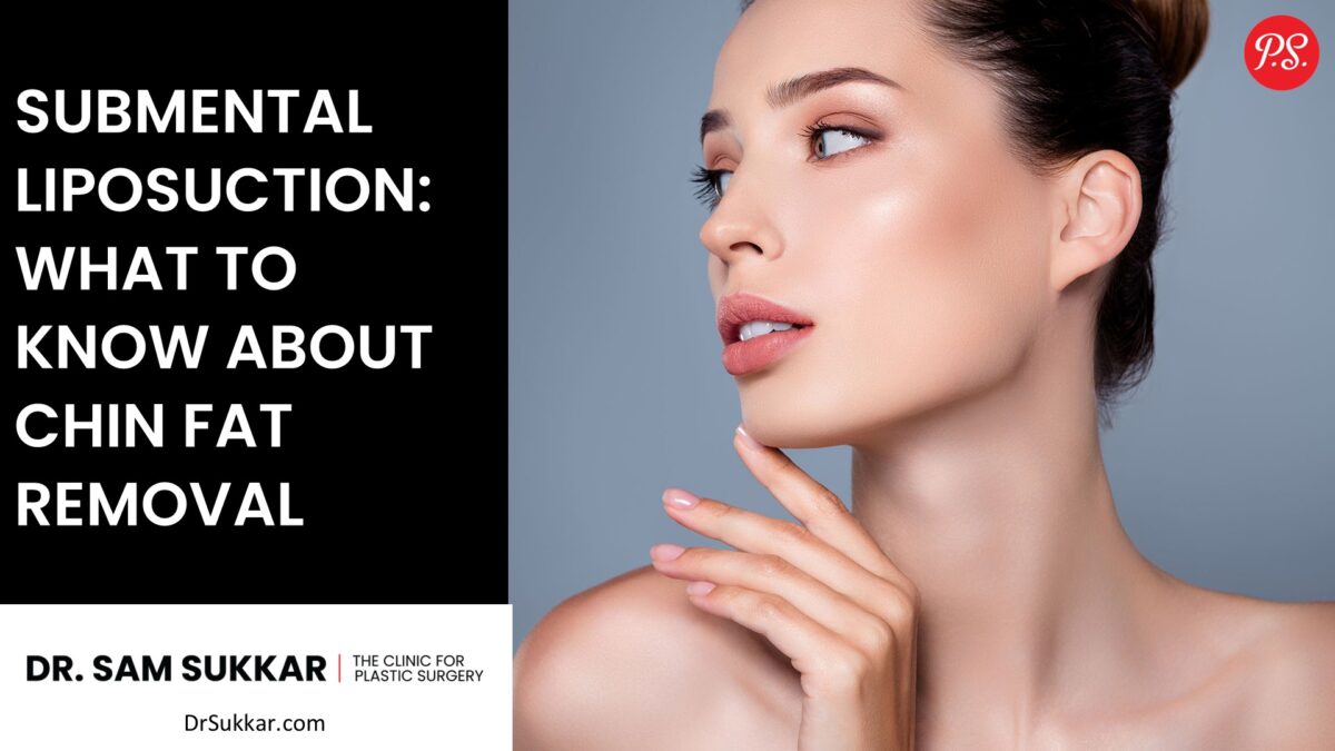 Submental Liposuction: What to Know About Chin Fat Removal by Dr. Sam Sukkar, MD