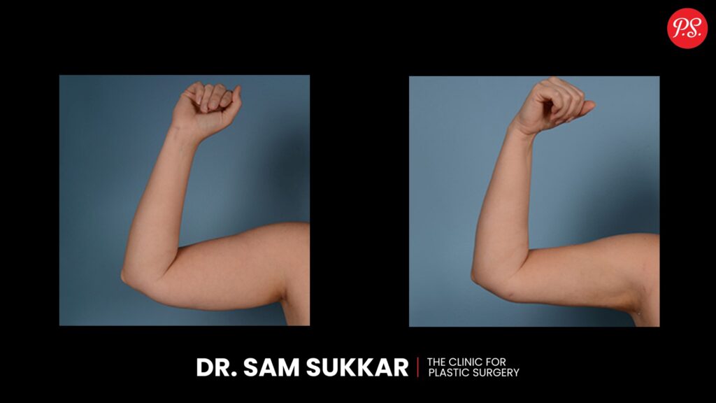 Arm Liposuction Before and After This Cosmetic Procedure  by Dr. Sam Sukkar, MD in Houston, Texas