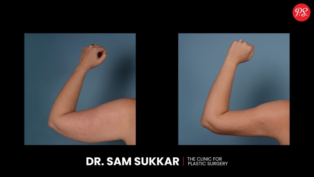 Arm Liposuction Before and After This Cosmetic Procedure by Dr. Sam Sukkar, MD in Houston, TX