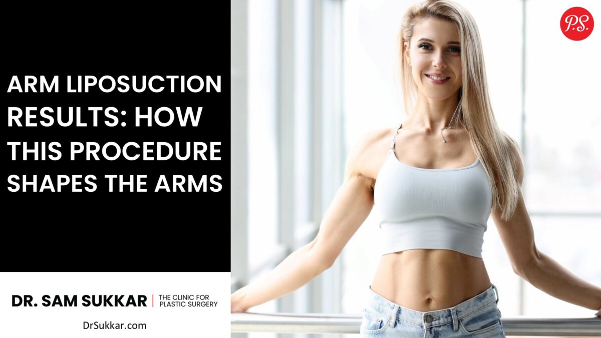 Arm Liposuction Results: How This Procedure Shapes the Arms By Dr. Sam Sukkar, MD