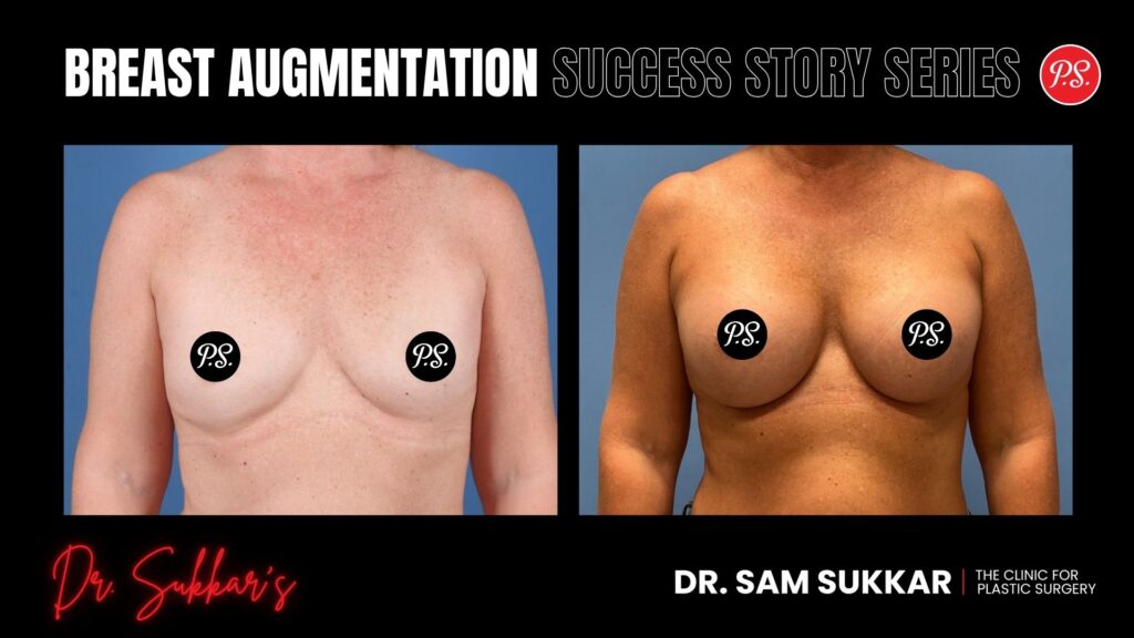 Breast Augmentation Success: Natural Results at 3 Months - Mommy Makeover Success Story Series in Houston, Texas by Dr. Sam Sukkar, MD