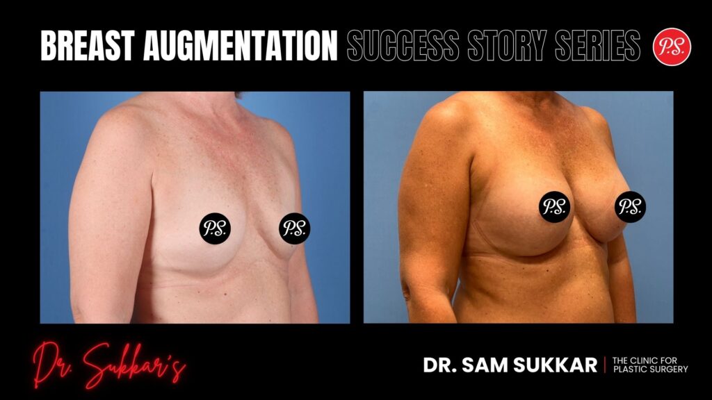 Breast Augmentation Success: Natural Results at 3 Months - Mommy Makeover Success Story Series in Houston, TX by Dr. Sam Sukkar, MD