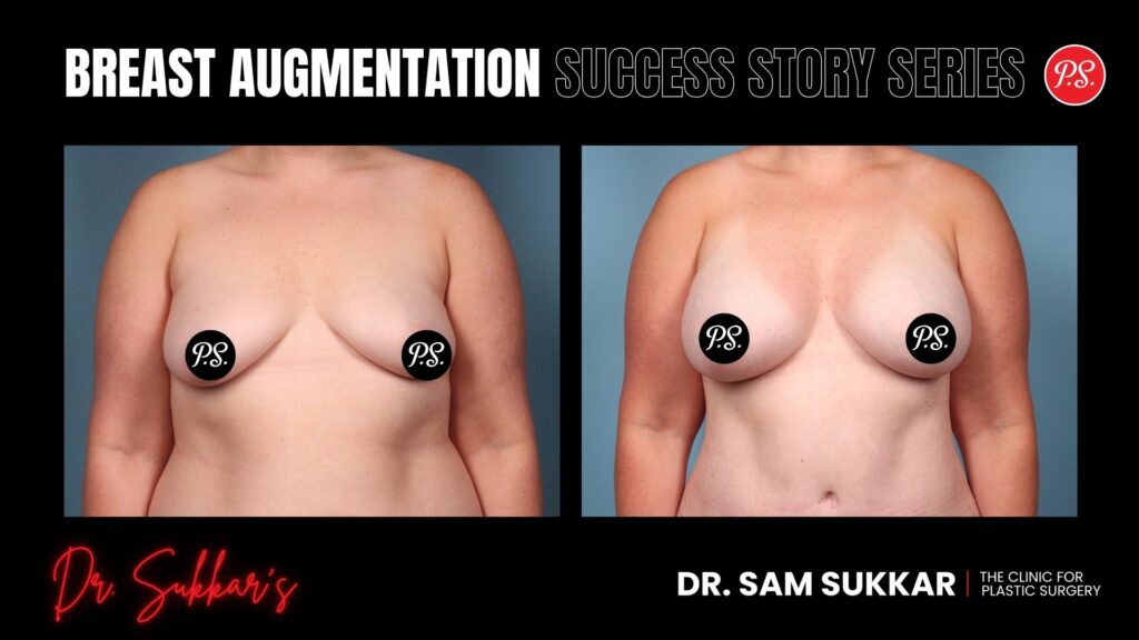 Breast Augmentation at 31: Houston Mom’s 550cc Transformation - Breast Augmentation Success Story Series in Houston, Texas by Dr. Sam Sukkar, MD
