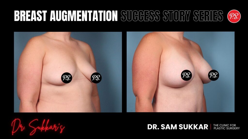 Breast Augmentation at 31: Houston Mom’s 550cc Transformation - Breast Augmentation Success Story Series in Houston, TX by Dr. Sam Sukkar, MD