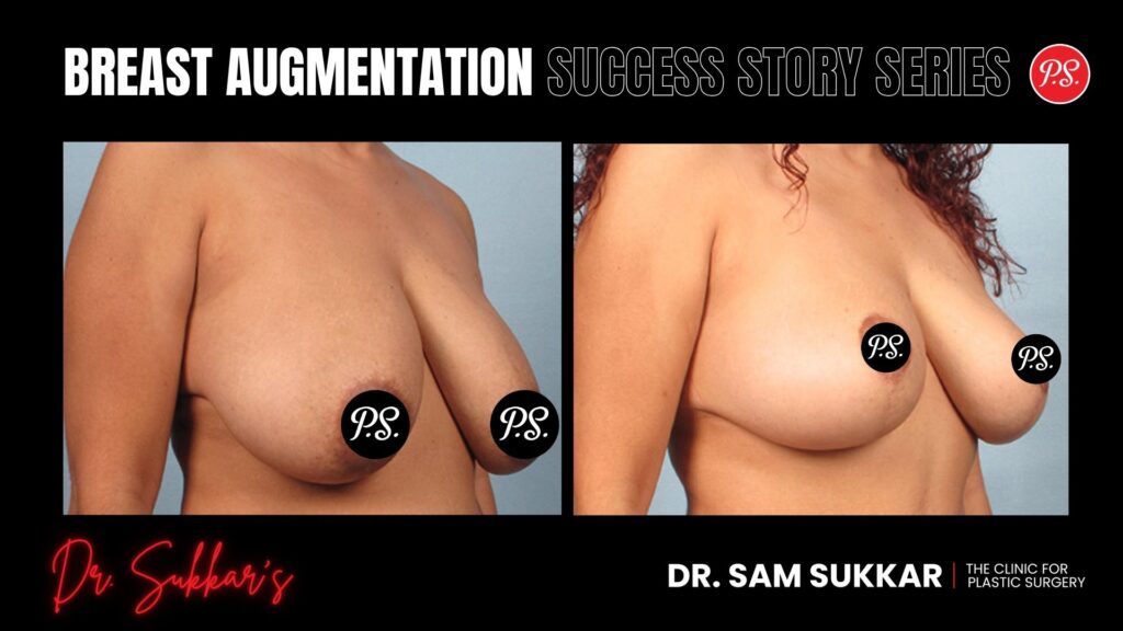 Breast Lift Success: Houston, TX Mom’s Journey to Restored Confidence - Breast Lift Success Story Series