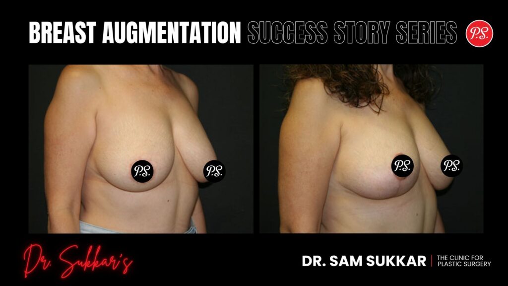 Breast Lift at 48: Houston Woman’s Journey to Restored Confidence - Mommy Makeover Success Story Series by Dr. Sam Sukkar, MD in Houston, TX