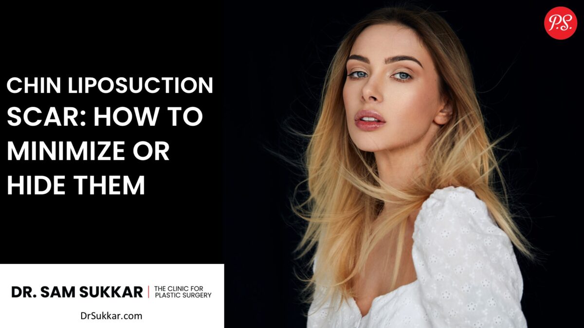 Chin Liposuction Scar: How to Minimize or Hide Them By Dr Sam Sukkar MD