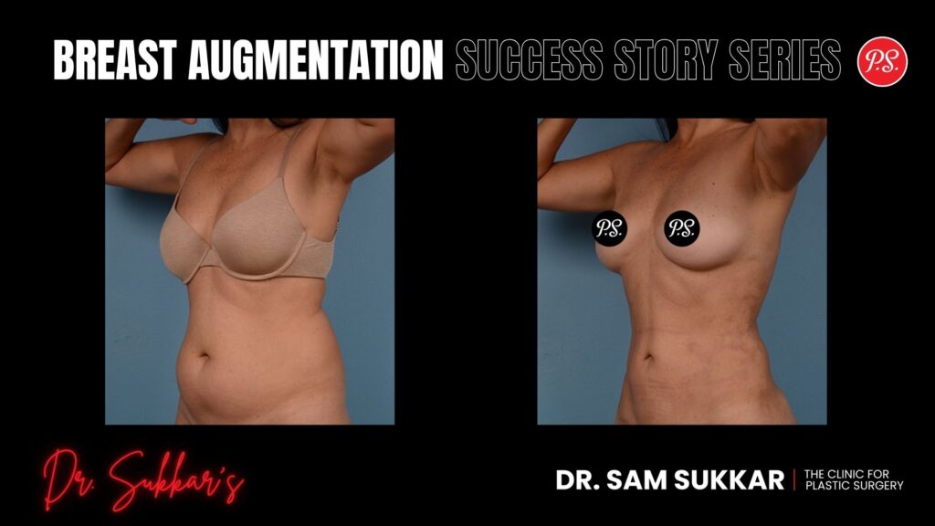 Liposuction at 50: Houston Woman’s Hourglass Transformation - Mommy Makeover Success Story Series by Dr. Sam Sukkar, MD in Houston, TX