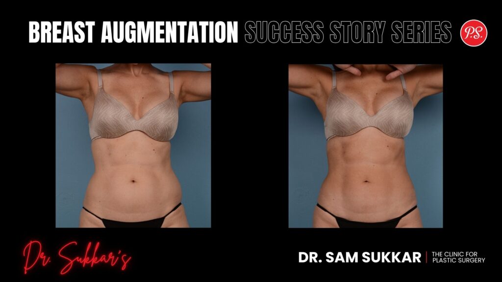 VASER Lipo Five Areas: 34-Year-Old's Houston, Texas Transformation - Liposuction Success Story