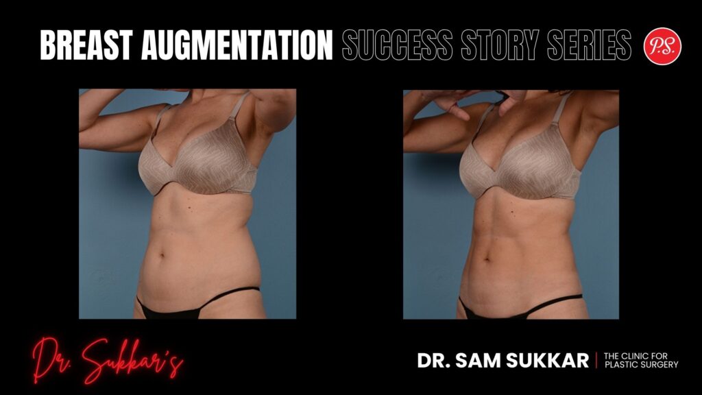VASER Lipo Five Areas: 34-Year-Old's Houston, TX Transformation - Liposuction Success Story