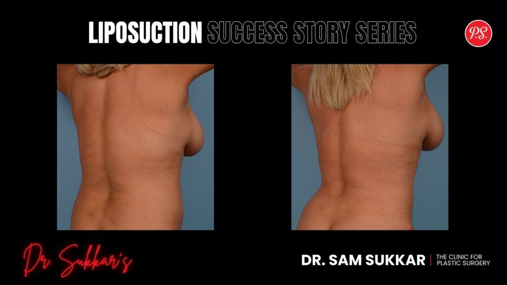 Liposuction with BBL: 55-Year-Old’s Houston Transformation - Liposuction Success Story Series in Houston, TX by Dr. Sam Sukkar, MD