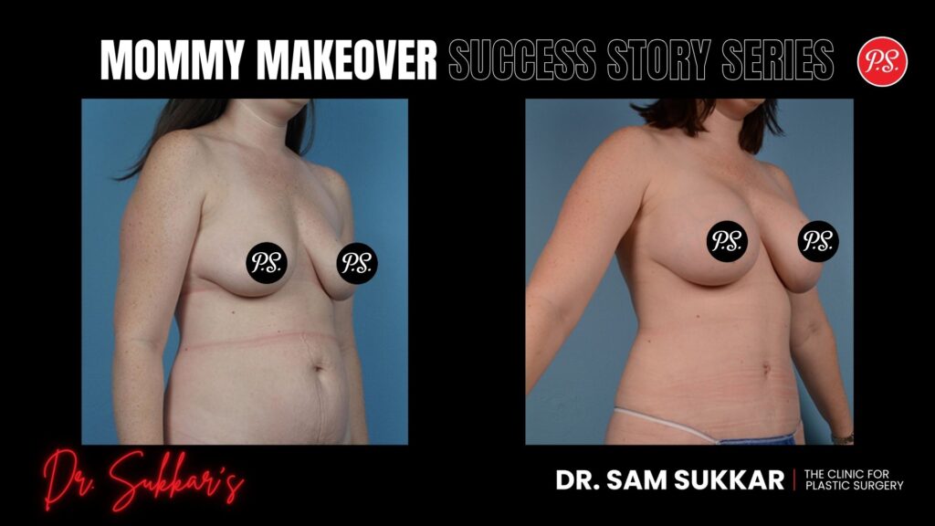 Mommy Makeover Success: Friend Referral Leads to Houston Mom’s Dream Results - Mommy Makeover Success Story Series in Houston, TX by Dr. Sam Sukkar, MD