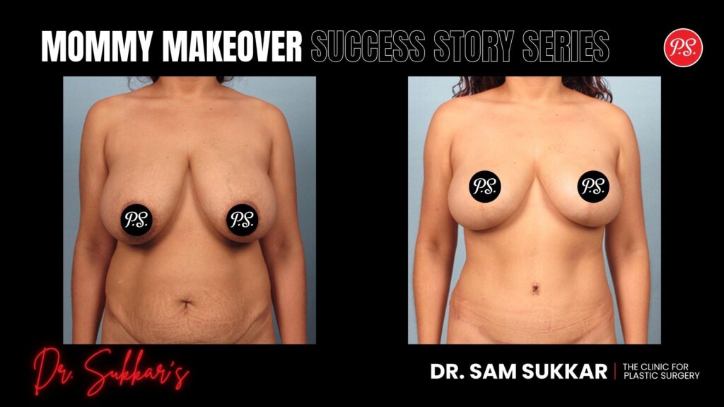 Mommy Makeover at 39: Houston, TX Mom’s Complete Transformation - Mommy Makeover Success Story Series