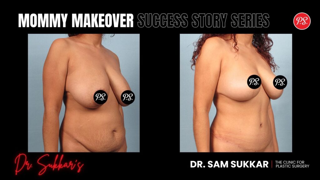 Mommy Makeover at 39: Houston, Texas Mom’s Complete Transformation - Mommy Makeover Success Story Series