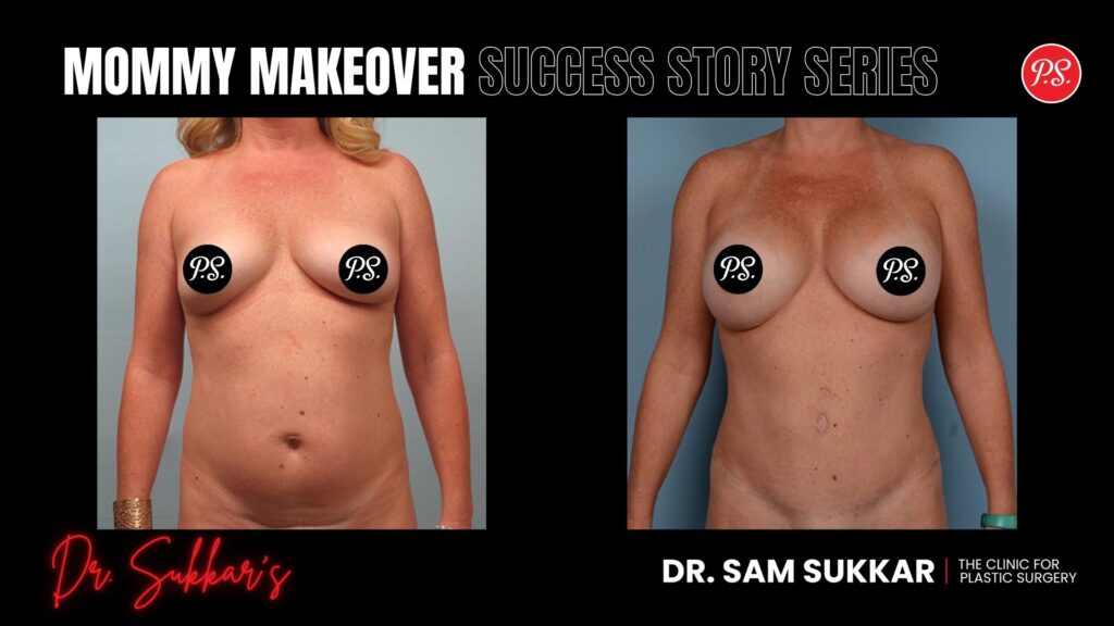 Mommy Makeover Referral: Friend’s Success Leads to Own Transformation - Mommy Makeover Success Story Series by Dr. Sam Sukkar, MD in Houston, Texas