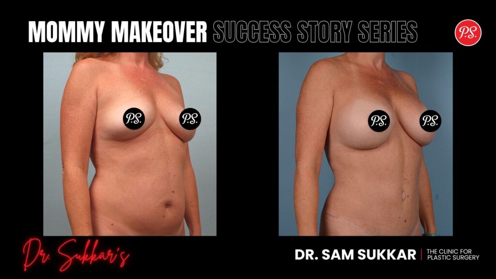 Mommy Makeover Referral: Friend’s Success Leads to Own Transformation - Mommy Makeover Success Story Series by Dr. Sam Sukkar, MD in Houston, TX