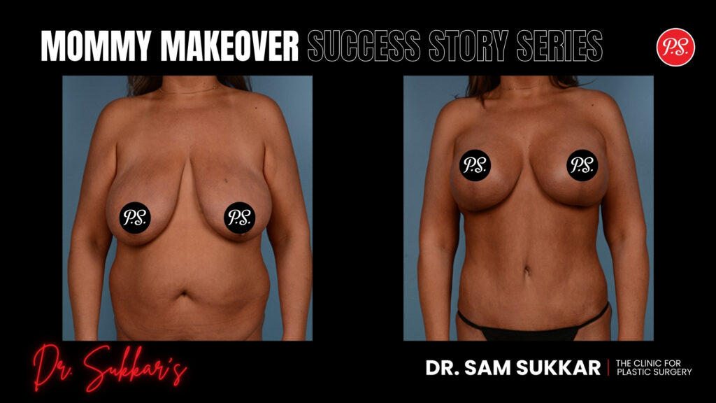 Mommy Makeover Success Story Series - Two-Step Mommy Makeover: 44-Year-Old's Houston Journey