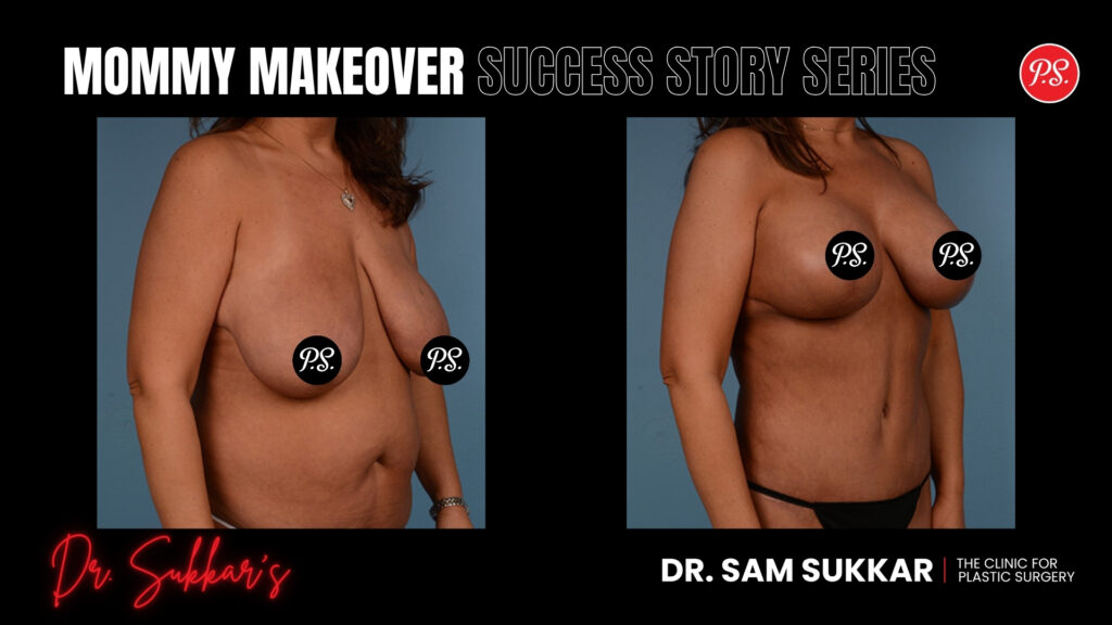 Mommy Makeover Success Story Series - Two-Step Mommy Makeover: 44-Year-Old's Houston Journey By Dr. Sam Sukkar, MD