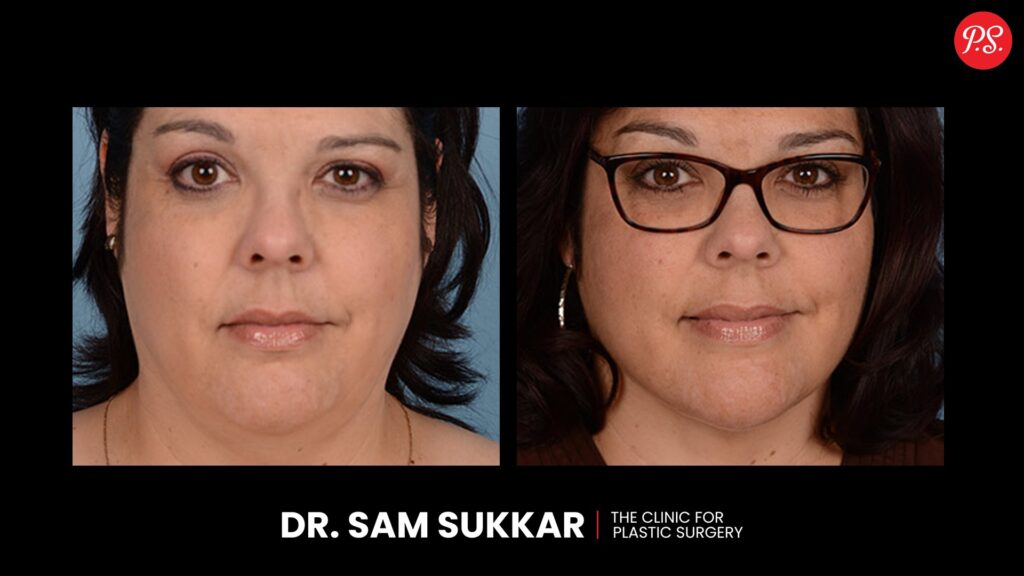 Neck Liposuction Before and After Transformations in Houston, Texas by Dr. Sam Sukkar, MD